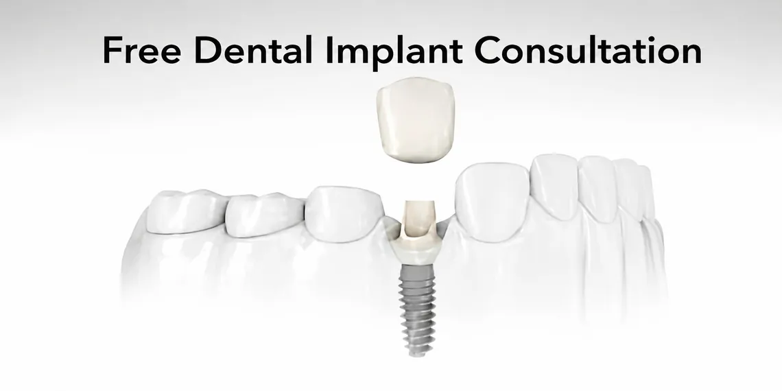 Free Dental Implant Consultation at Finch Midland Dental