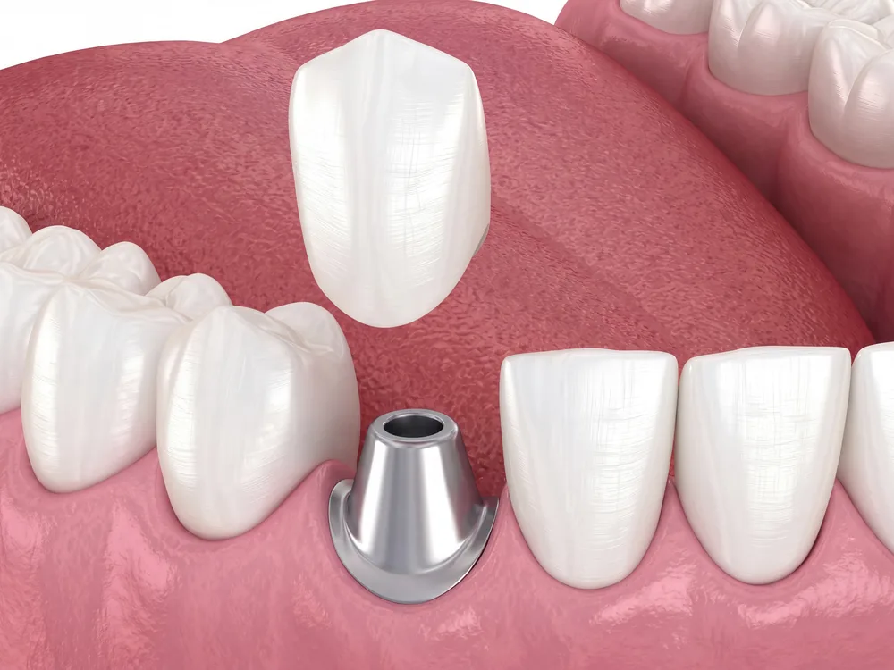 Illustration of a dental crown being placed on an implant