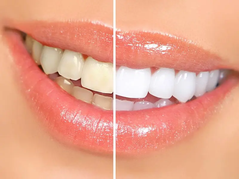 Managing Tooth Sensitivity During Whitening