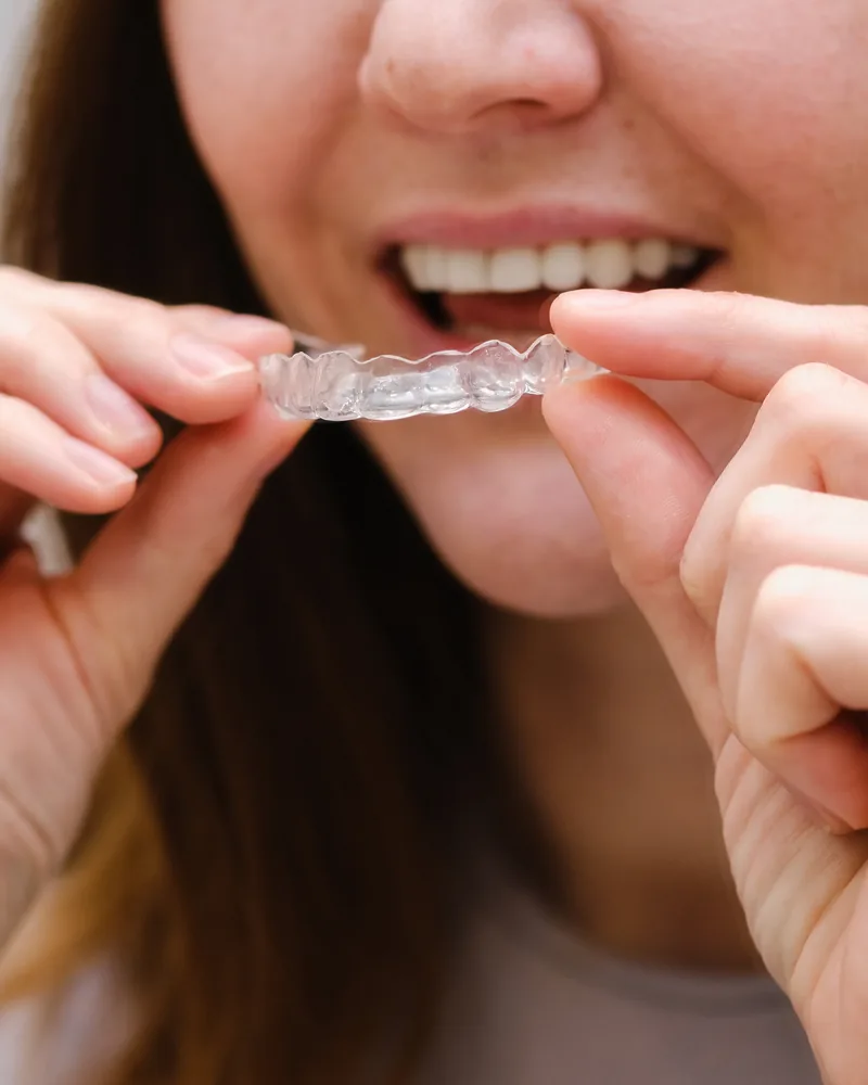 A woman fitting a clear aligner over her teeth